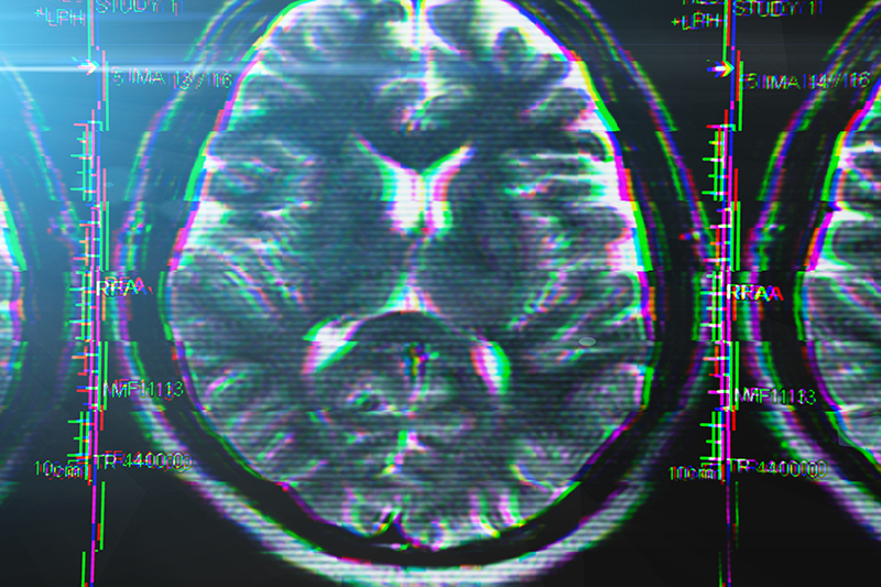 Are You Predisposed to Alzheimer’s Disease? What to Consider Before Taking a Genetic Test