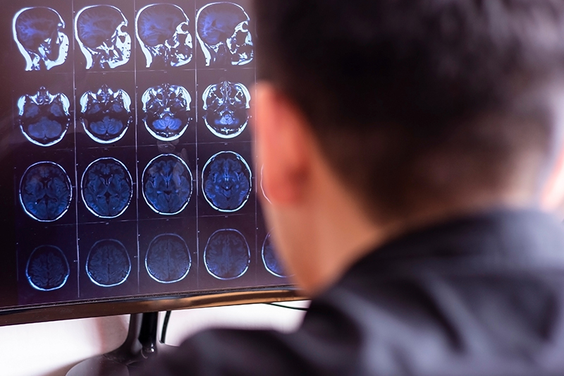 Are You Predisposed to Alzheimer’s Disease? What to Consider Before Taking A Genetic Test, Continued